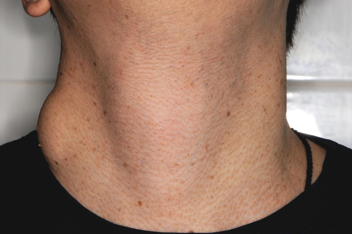Neck lipoma