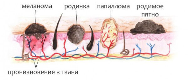 Malignant neoplasms of the skin