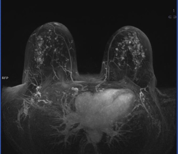 Breast MRI scan