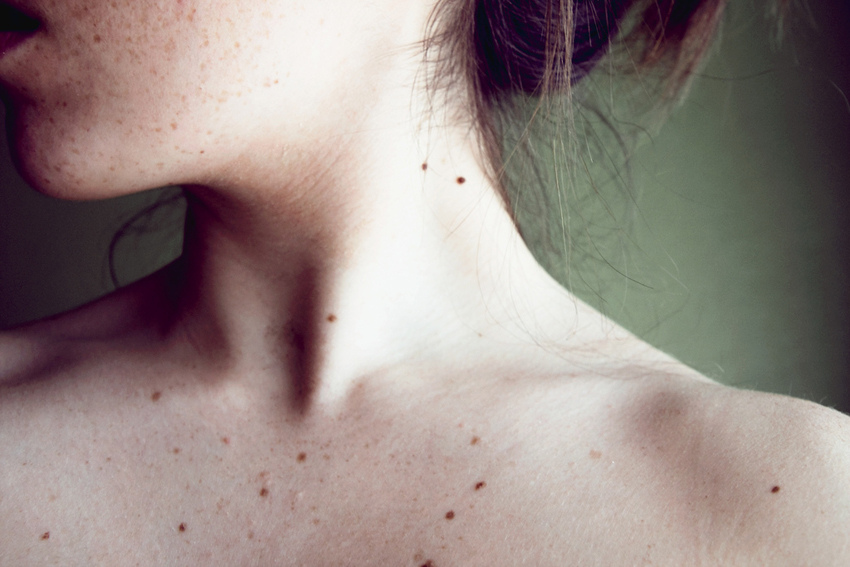  Benign skin growths
