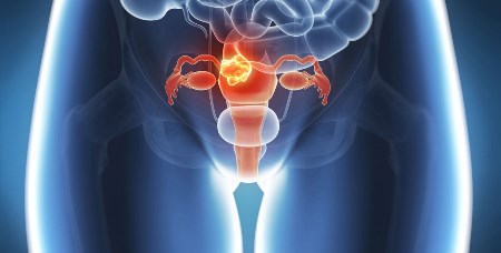 uterine cancer