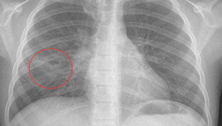 rib fracture how much does it heal