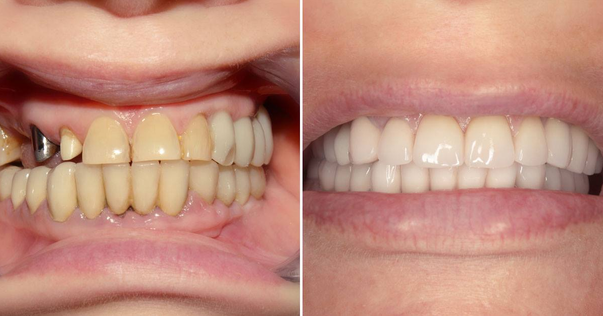 prosthetics of teeth
