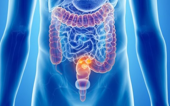 rectal cancer treatment in Moscow