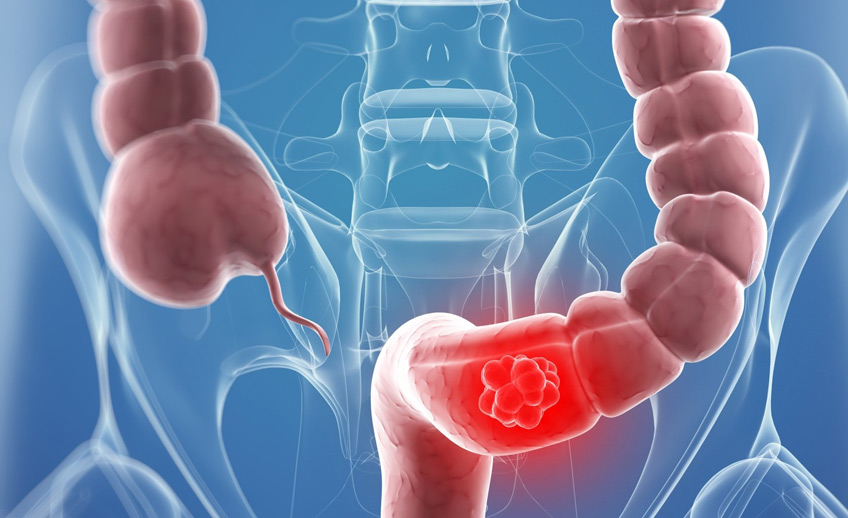 bowel cancer treatment