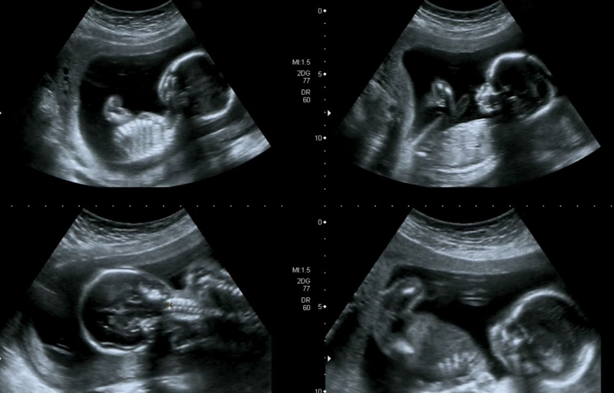Treatment of intrauterine growth retardation in Moscow