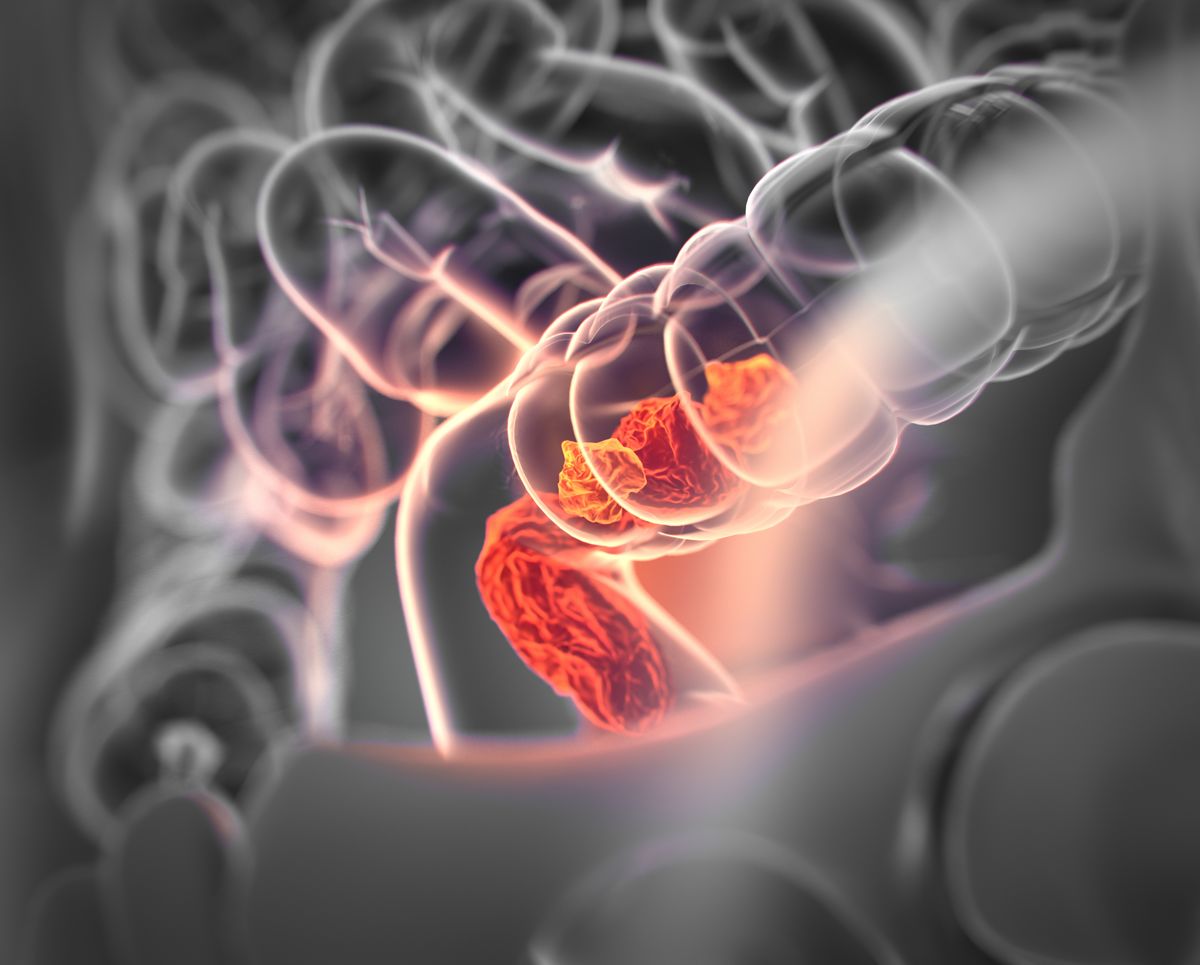 Prevalence of colorectal cancer
