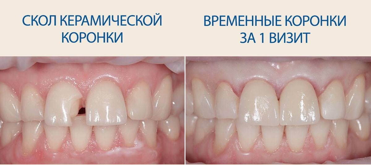 crowns for 1 day