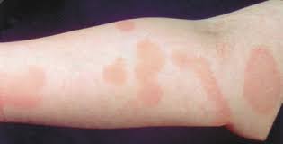 Treatment of parapsoriasis