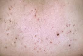 Treatment of parapsoriasis