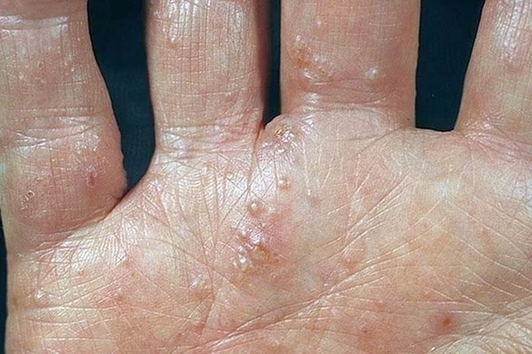 Eczema - symptoms and treatment methods in EMC