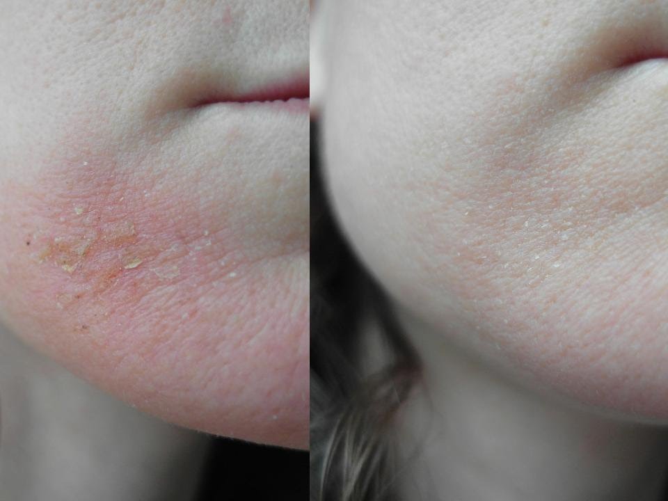 Eczema - symptoms and treatment methods in EMC