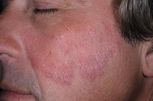 Eczema - symptoms and treatment methods in EMC