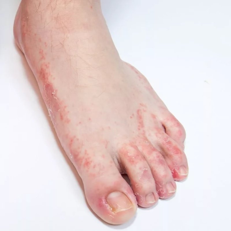 Eczema - symptoms and treatment methods in EMC