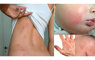 Eczema - symptoms and treatment methods in EMC