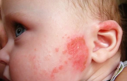 Eczema - symptoms and treatment methods in EMC