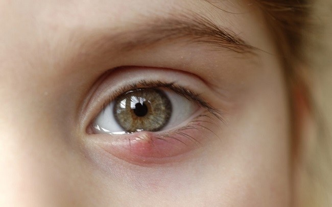 Halyazion: symptoms and treatment methods in EMC
