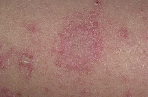 Eczema - symptoms and treatment methods in EMC