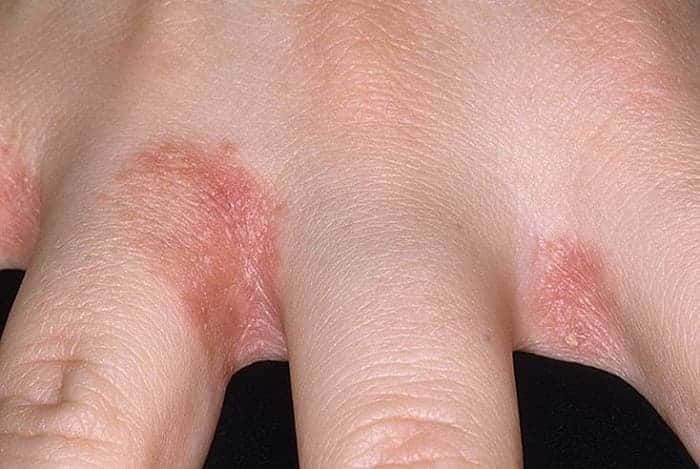 Eczema - symptoms and treatment methods in EMC