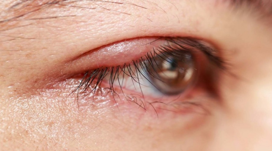 Halyazion: symptoms and treatment methods in EMC
