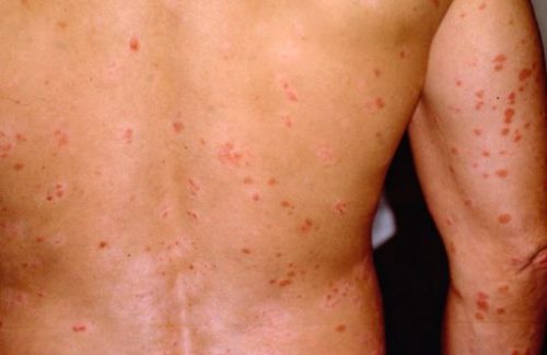 Treatment of parapsoriasis