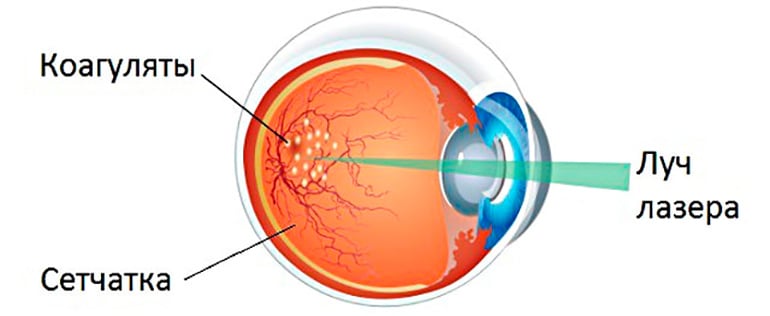 Retinal laser coagulation: symptoms and treatment options in EMC
