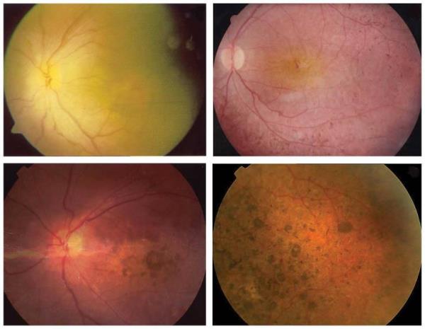 Retinal laser coagulation: symptoms and treatment options in EMC