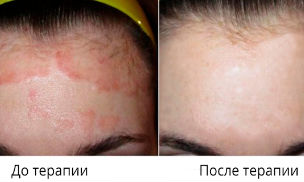 Eczema - symptoms and treatment methods in EMC