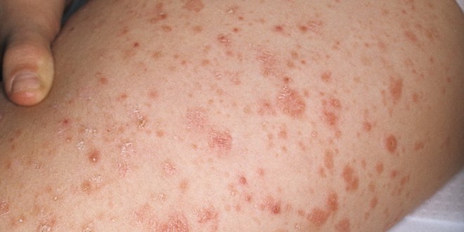 Treatment of parapsoriasis