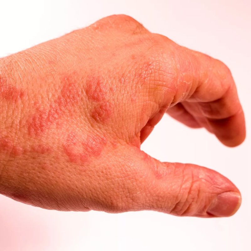 Eczema - symptoms and treatment methods in EMC