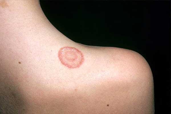 Eczema - symptoms and treatment methods in EMC