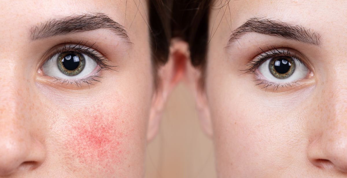 Treatment of rosacea in EMC