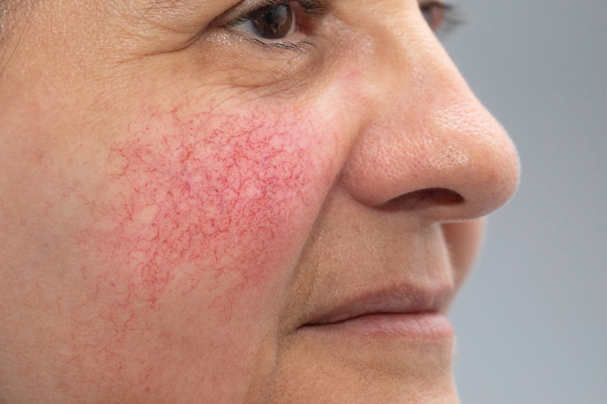 Treatment of rosacea in EMC