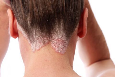 Eczema - symptoms and treatment methods in EMC