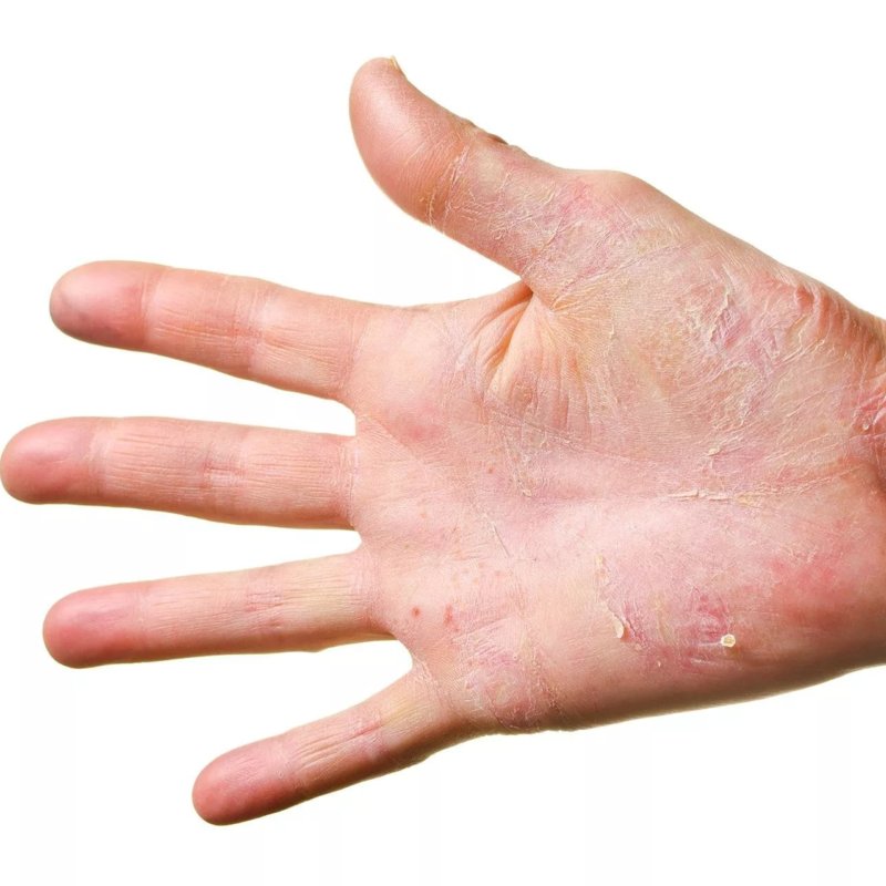 Eczema - symptoms and treatment methods in EMC