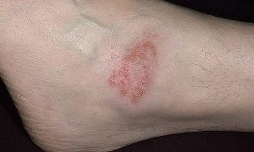 Eczema - symptoms and treatment methods in EMC