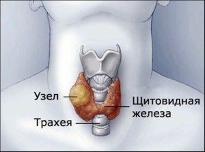 treatment of thyroid nodules
