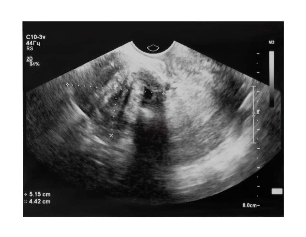 Uterine fibroids