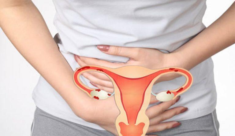 Endometriosis — symptoms and treatment