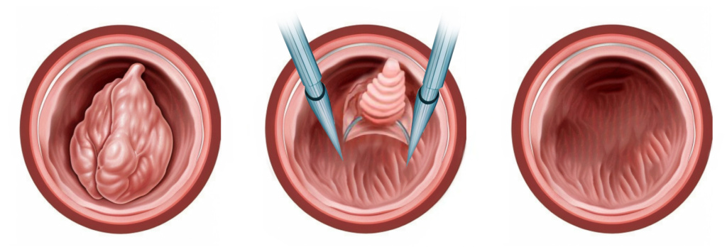 Cervical polyp removal