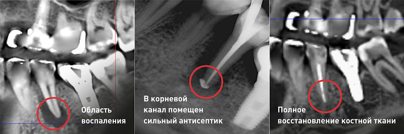 save complex tooth