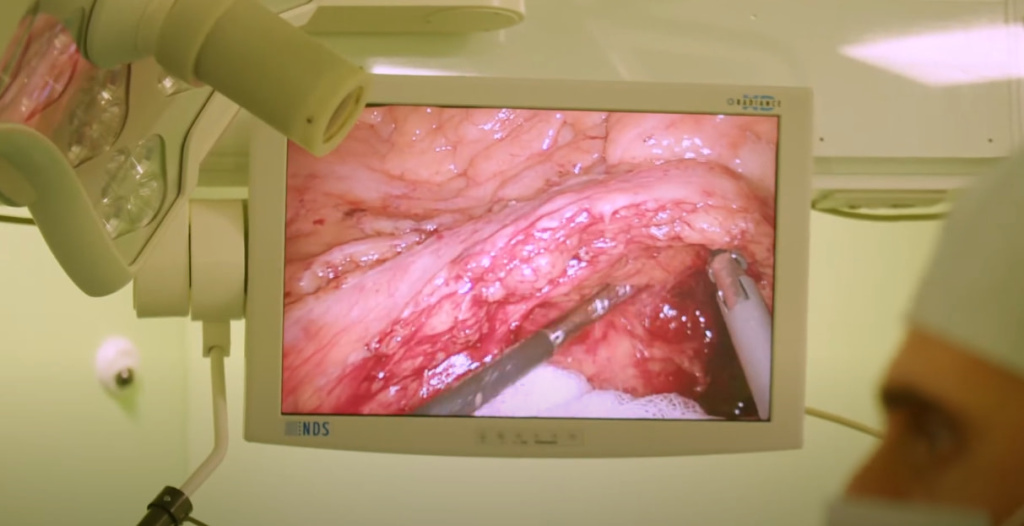Hernia treatment